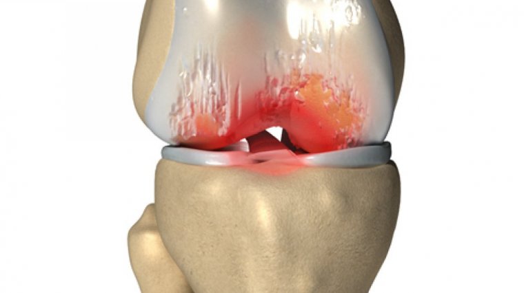 La inflamación está implicada en problemas comunes como la artritis de rodilla.