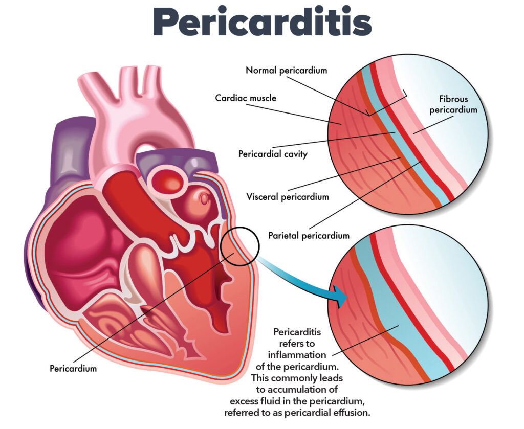 La pericarditis puede progresar a derrame pericárdico y eventualmente a taponamiento cardíaco. | Wikimedia Commons