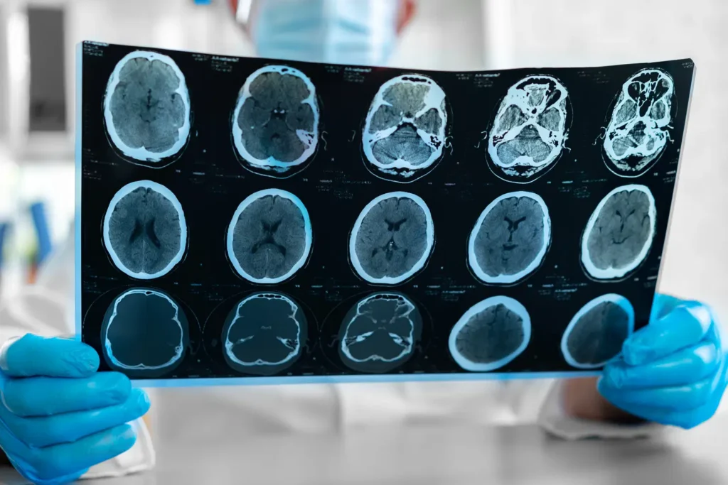Infarto cerebral causas y consecuencias