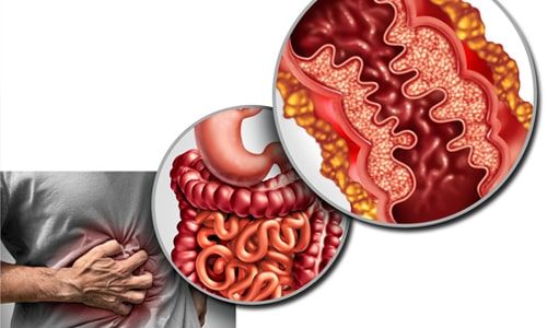 Enfermedad de Crohn: qué es, causas, síntomas y tratamiento