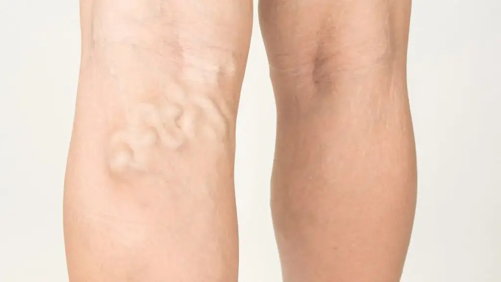 Las varices son venas inflamadas que suelen aparecer en las piernas.