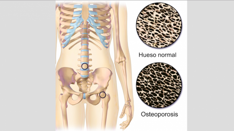 Ilustración de hueso normal comparado con hueso durante la osteoporosis.

