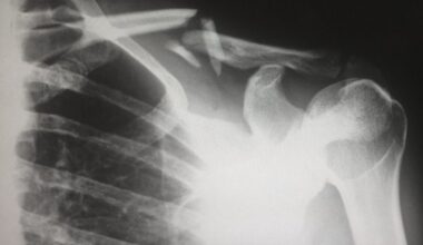 La osteoporosis es una enfermedad que afecta el sistema óseo.