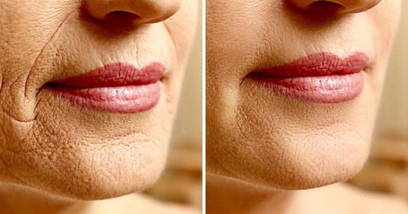 Los mejores métodos de rejuvenecimiento facial sin cirugía | Cedida